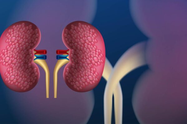 Children are now getting kidney stones: what needs to change to prevent this